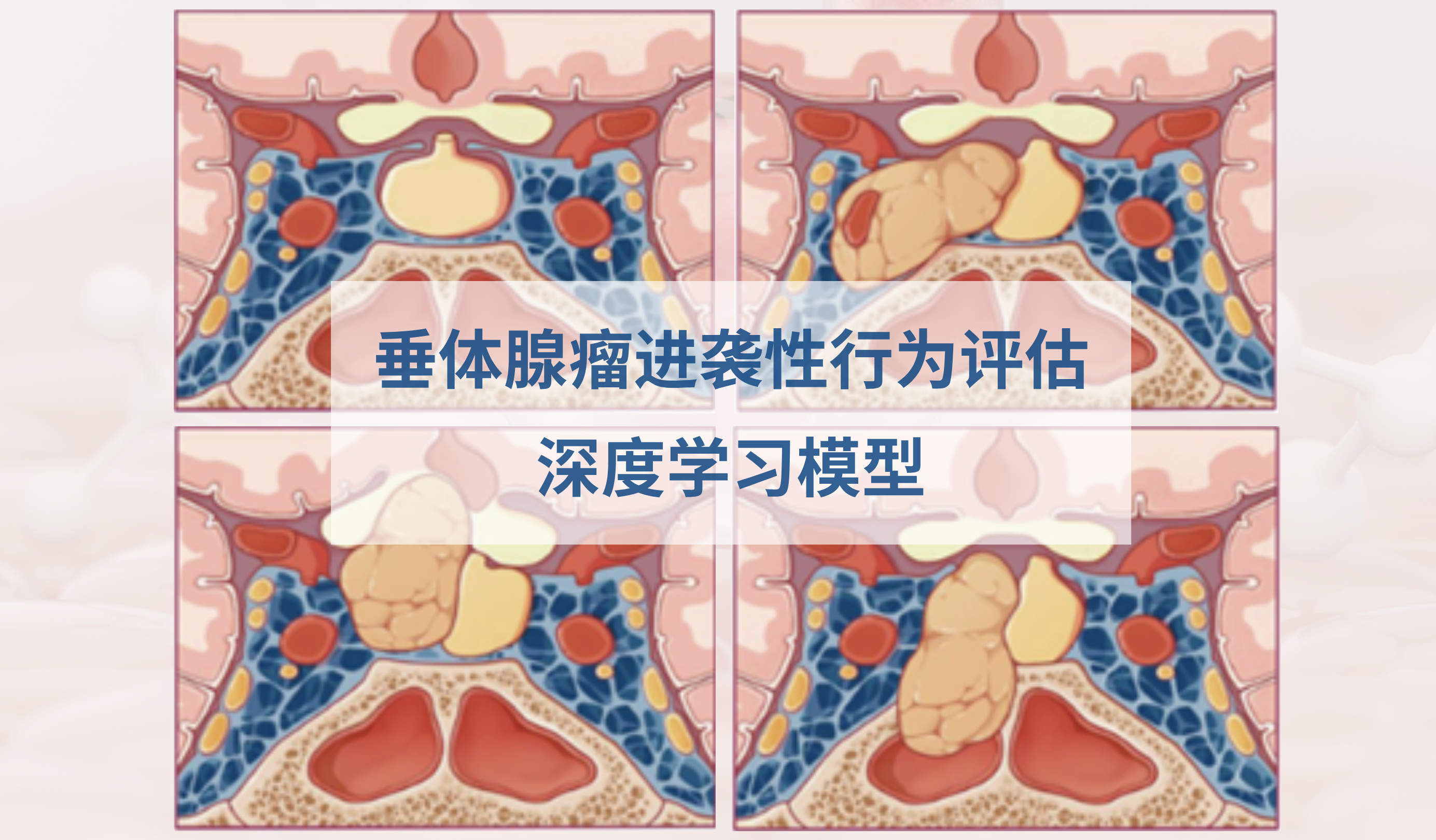 研究提出垂体腺瘤进袭性行为评估模型，助力肿瘤精准治疗